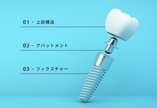 インプラントの構造